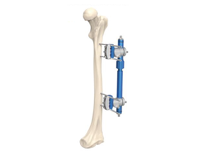 Micro-movement compression/distraction unilateral external fixator