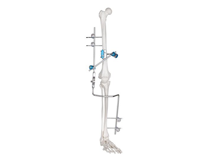knee joint fixator