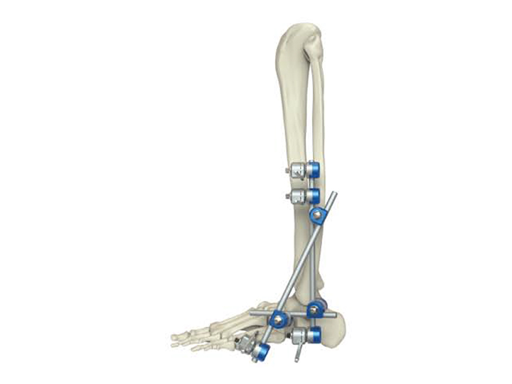 Ankle joint fixator