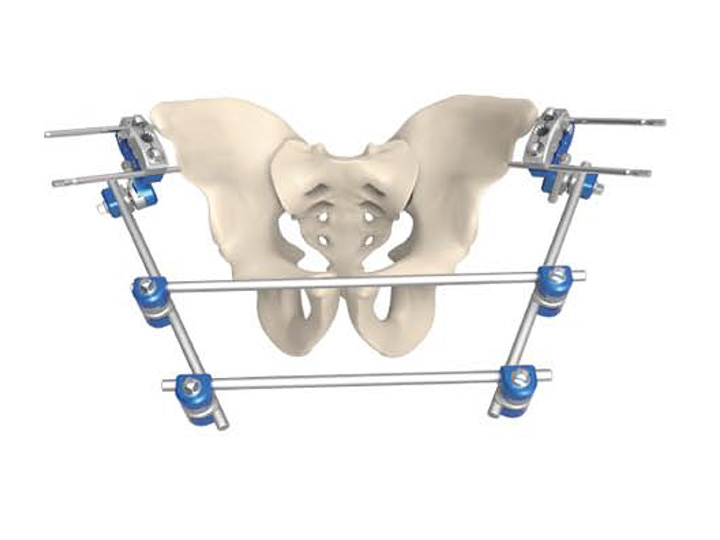 Pelvic fixator