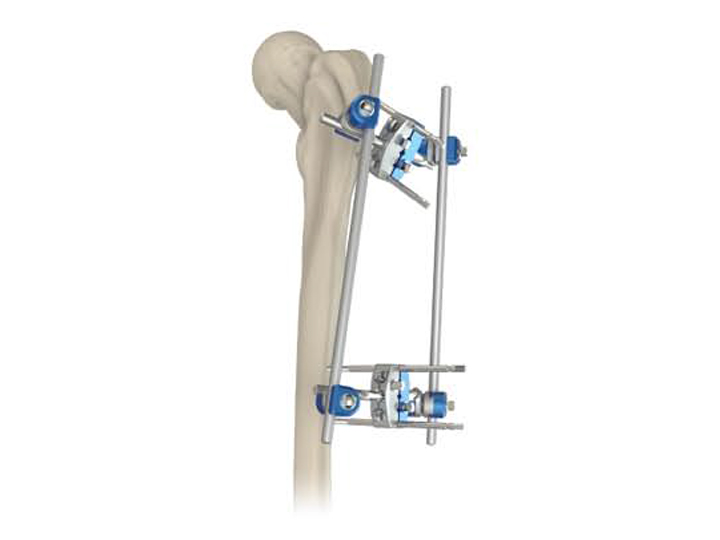 Proximal femur fixator