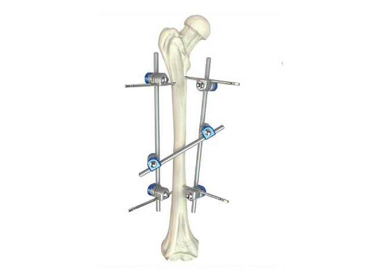 Femoral shaft fixator