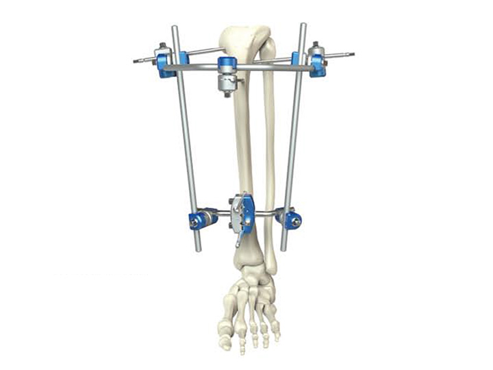 Proximal tibia external fixator