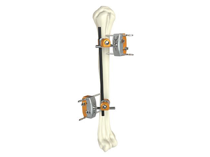 Humeral shaft external fixator