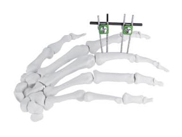 Mini-fixator (finger & palm)