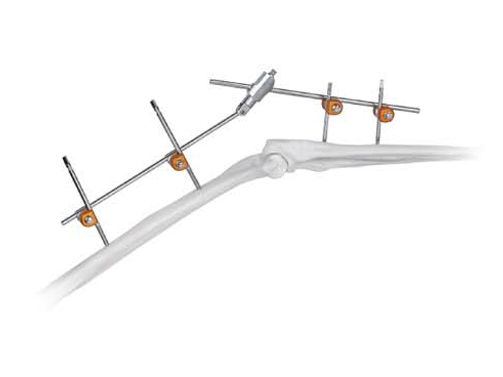Elbow joint fixator