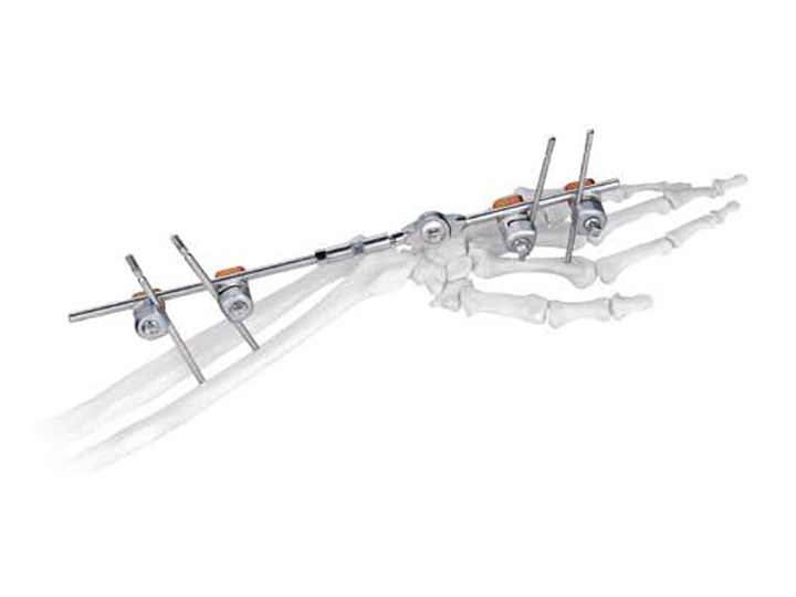 Wrist joint fixator