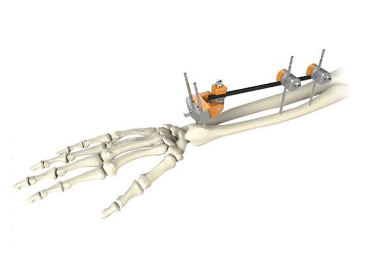 Distal radius fixator