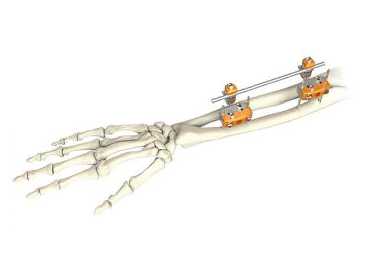 forearm fixator
