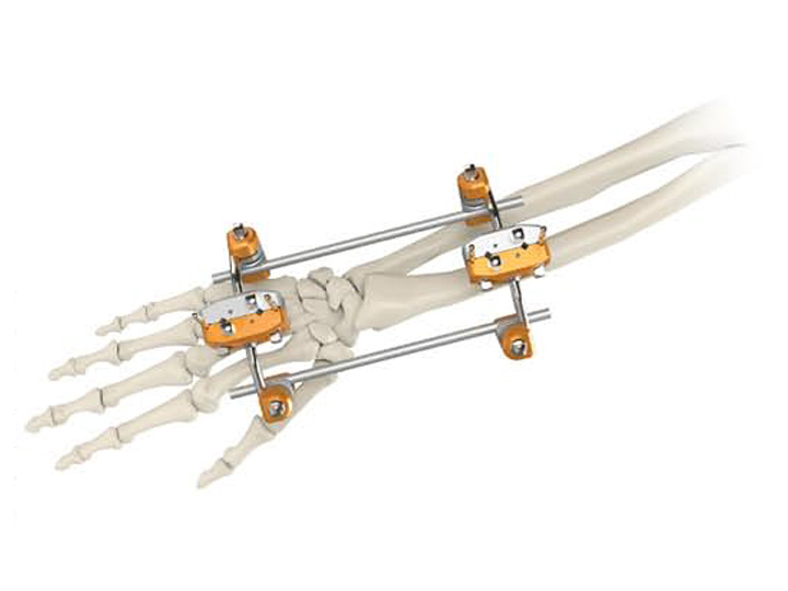 Ulna & radius spanning external fixator