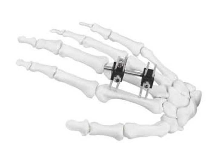 Mini fixator B type