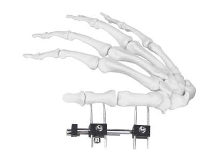 Mini fixator A type