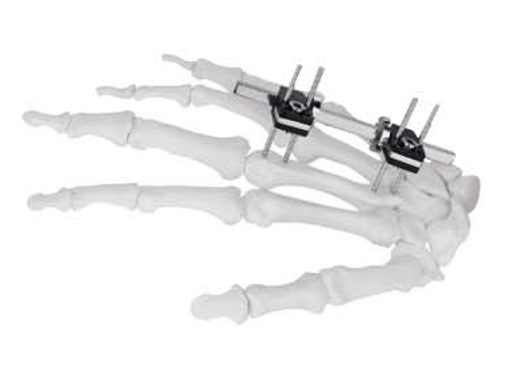 Mini fixator straight type