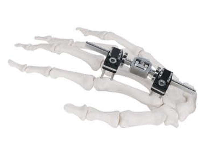 Mini fixator joint motion type