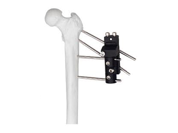 Pertrochanteric fixator