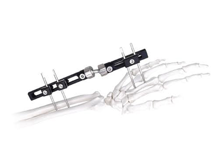 Wrist external fixator (single pin type)
