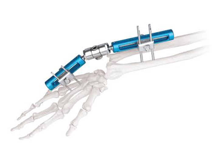 Wrist external fixator (Single locking type)