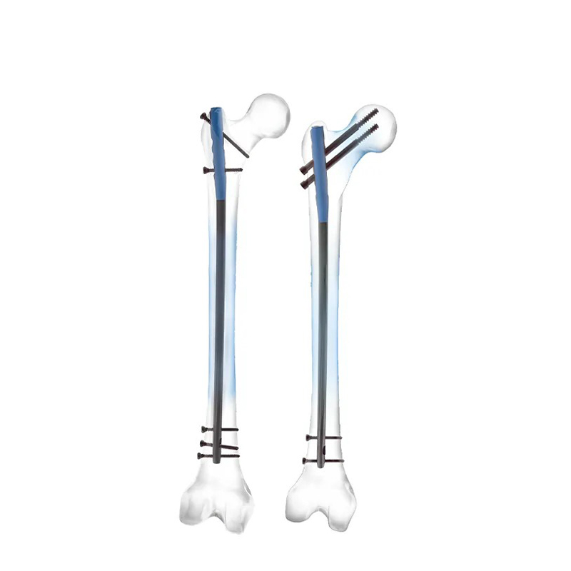 Expert Femoral Intramedullary Nail