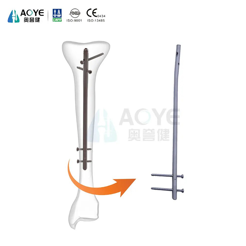 Tibial Intramedually Nail