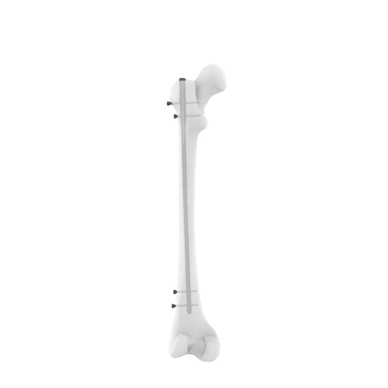 Femoral Intramedually Nail