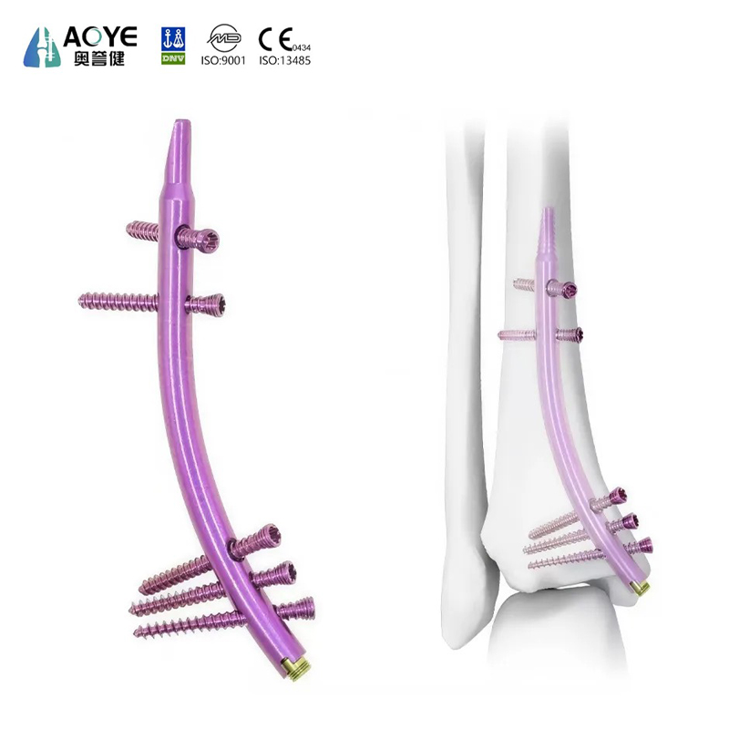 Distal Tibial Intramedullary Nail (DTN)