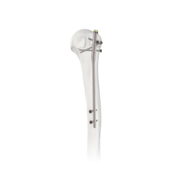 Humeral Intramedullary Nail